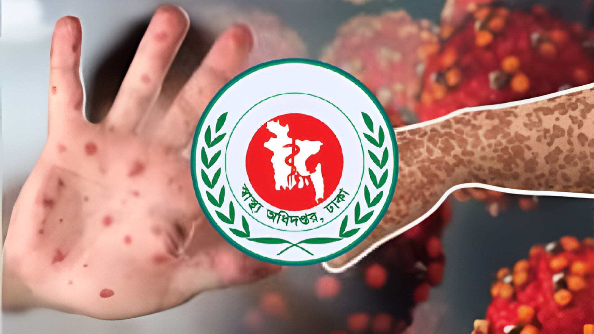 হামের প্রকোপে আরও ২ শিশুর মৃত্যু, মৃত ৭৪৭